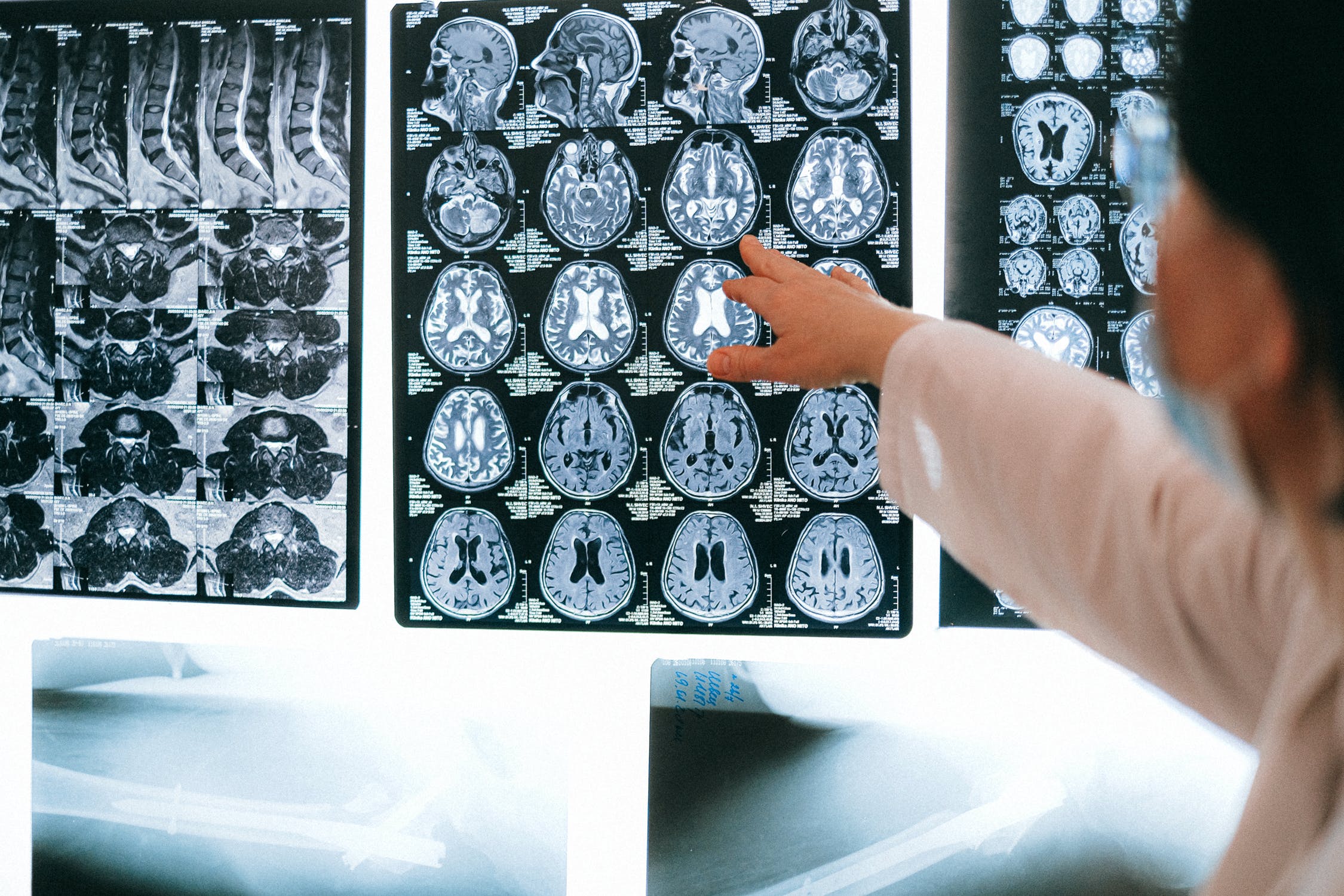 Experts fear a ‘silent wave’ of Parkinson’s disease
